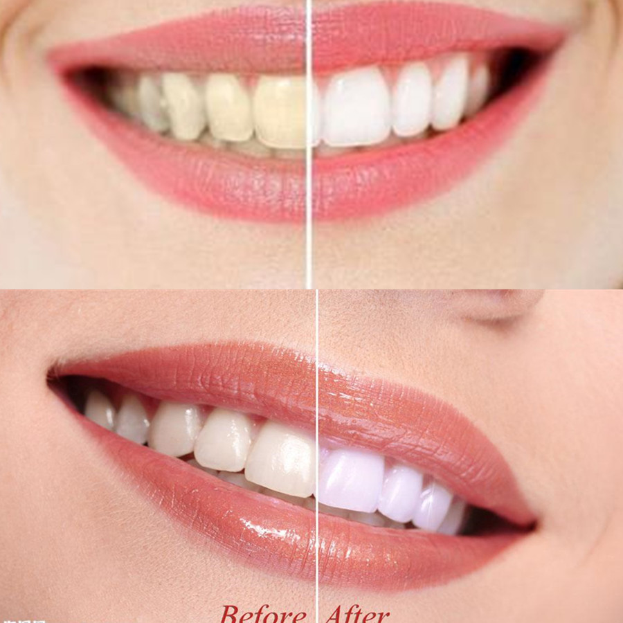 الخيزران الفحم الأسنان الأسنان - مراجعة Teeth Whitening Near Me وسعره