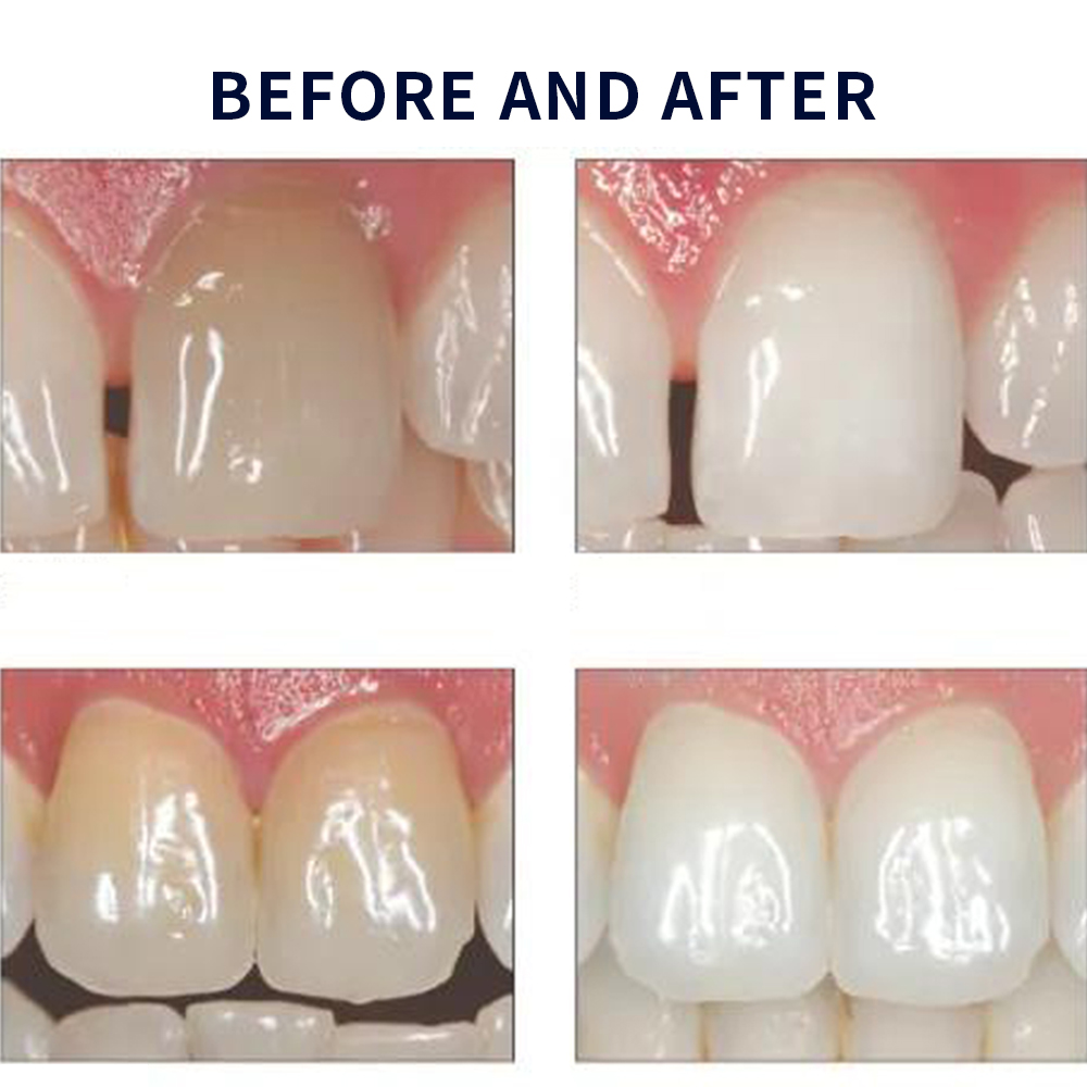 مجموعة جل تبييض أوباليزانس ، م - مراجعة Teeth Whitening Near Me وسعره