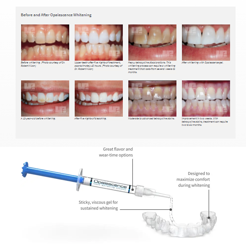 مجموعة جل تبييض أوباليزانس ، م - مراجعة Teeth Whitening Near Me وسعره