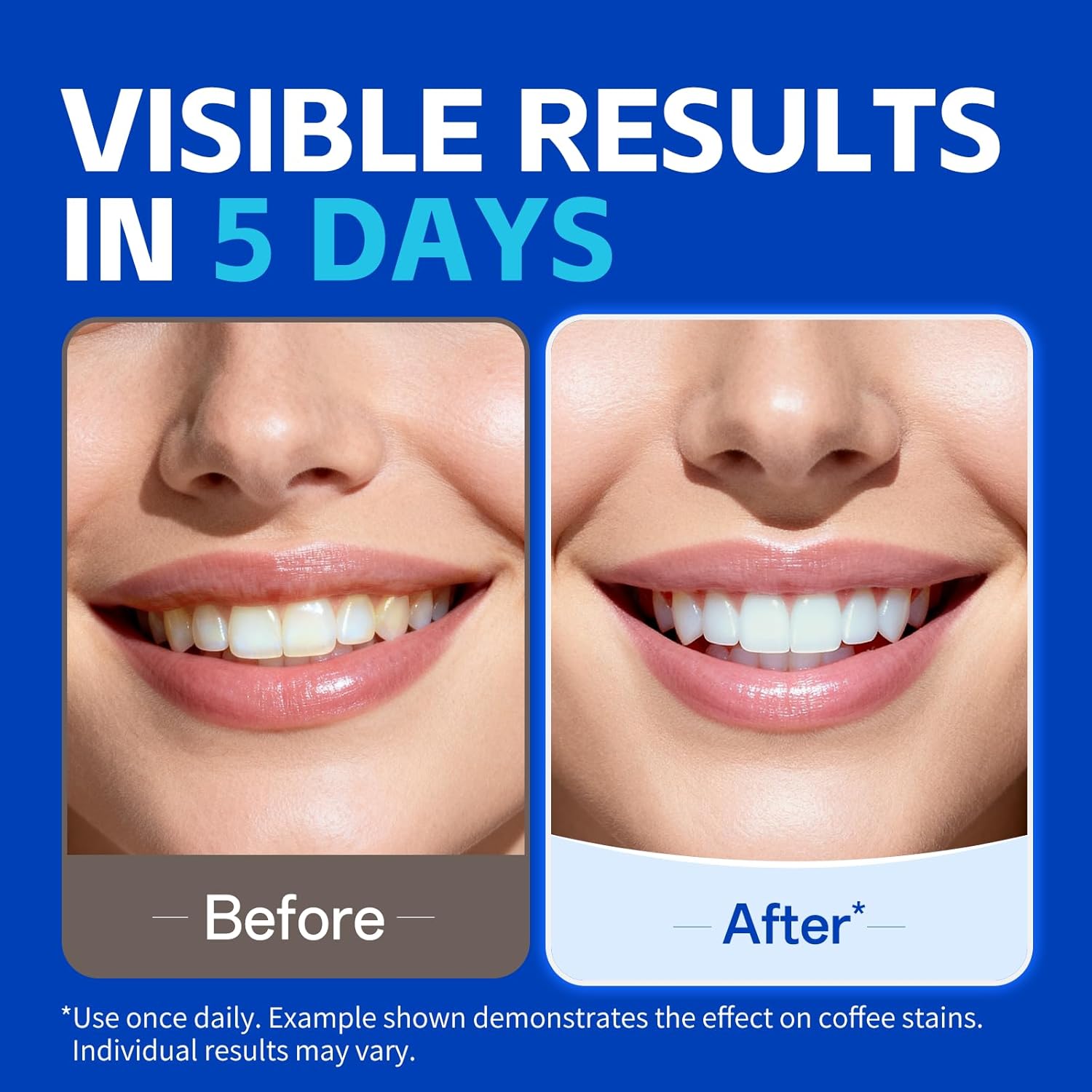 1/7 أزواج من شرائط تبييض الأسن - مراجعة Teeth Whitening Retainer وسعره