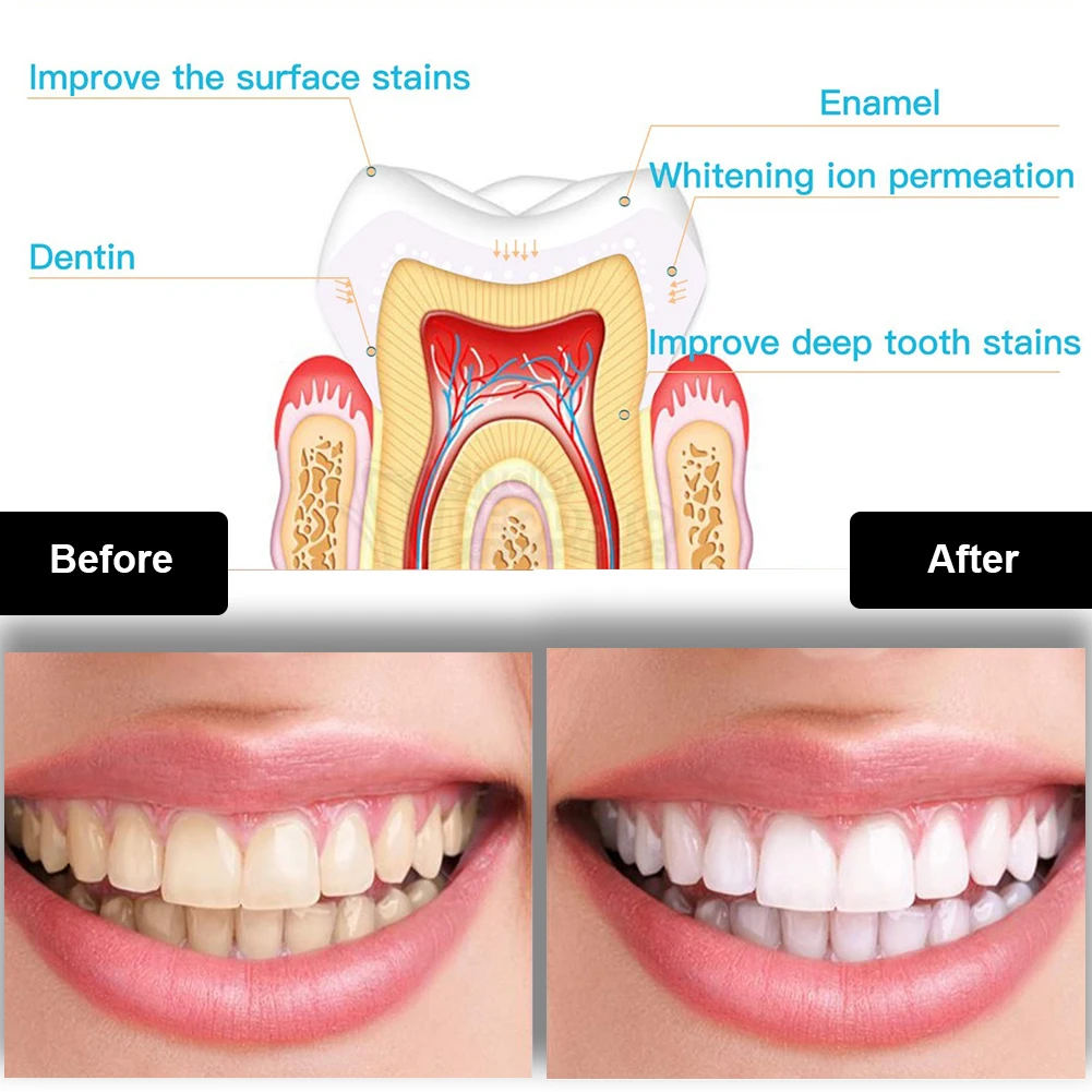 طقم تبييض الأسنان صغير 16 LED  - مراجعة Teeth Whitening Near Me وسعره